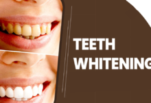 teeth whitening near me